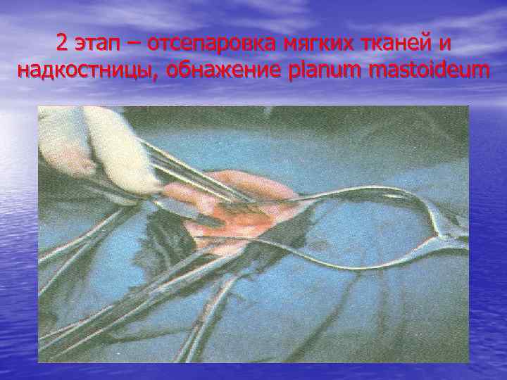 2 этап – отсепаровка мягких тканей и надкостницы, обнажение planum mastoideum 