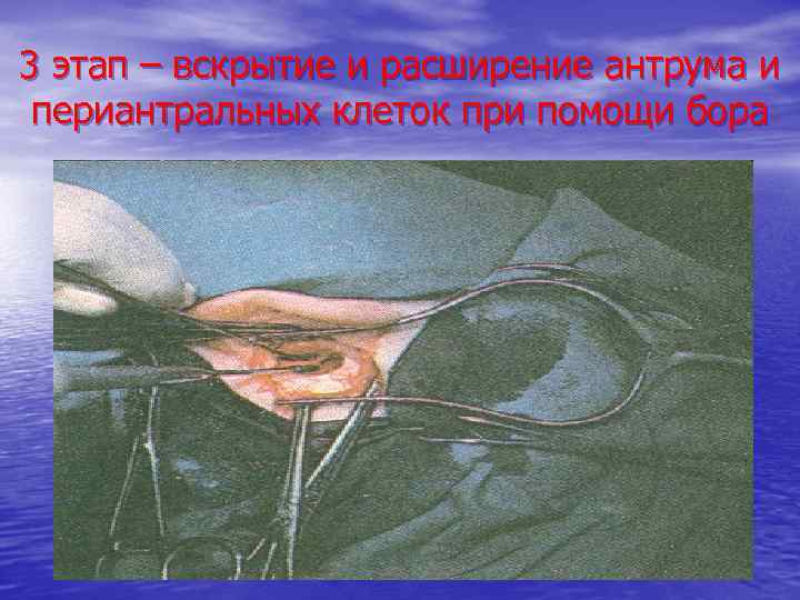 3 этап – вскрытие и расширение антрума и периантральных клеток при помощи бора 