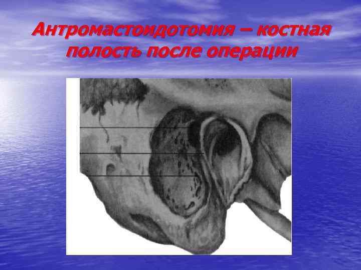 Антромастоидотомия – костная полость после операции 