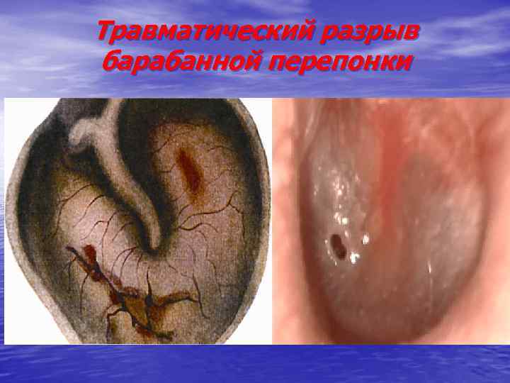 Травматический разрыв барабанной перепонки 
