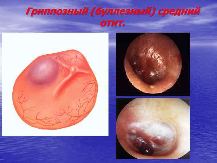 Гриппозный (буллезный) средний отит. 