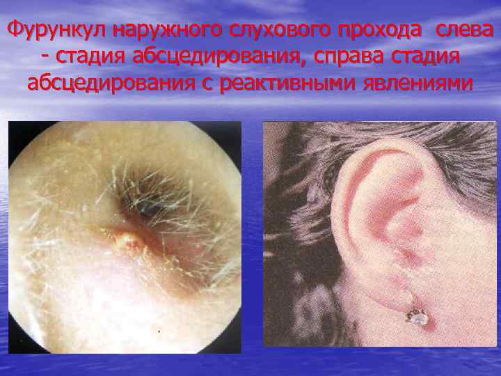 Фурункул наружного слухового прохода слева - стадия абсцедирования, справа стадия абсцедирования с реактивными явлениями