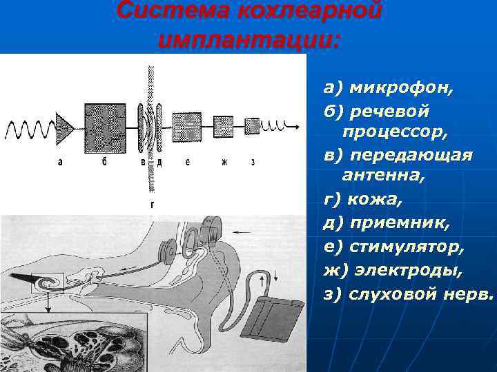 Система кохлеарной имплантации: а) микрофон, б) речевой процессор, в) передающая антенна, г) кожа, д)