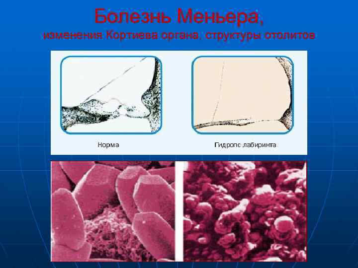 Болезнь Меньера, изменения Кортиева органа, структуры отолитов 
