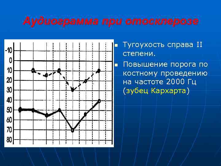 Аудиограмма при отосклерозе n n Тугоухость справа II степени. Повышение порога по костному проведению