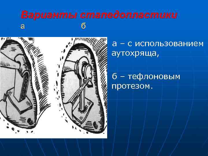Варианты стапедопластики а б а – с использованием аутохряща, б – тефлоновым протезом. 