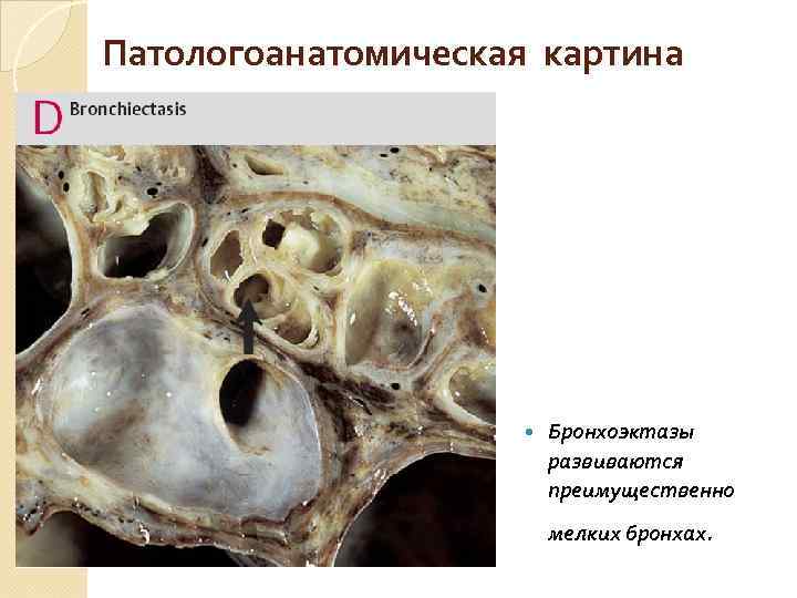 Патологоанатомическая картина Бронхоэктазы развиваются преимущественно мелких бронхах. 