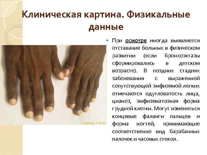 Клиническая картина. Физикальные данные При осмотре иногда выявляется отставание больных в физическом развитии (если