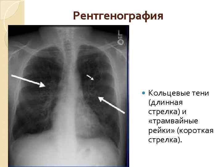 Рентгенография Кольцевые тени (длинная стрелка) и «трамвайные рейки» (короткая стрелка). 