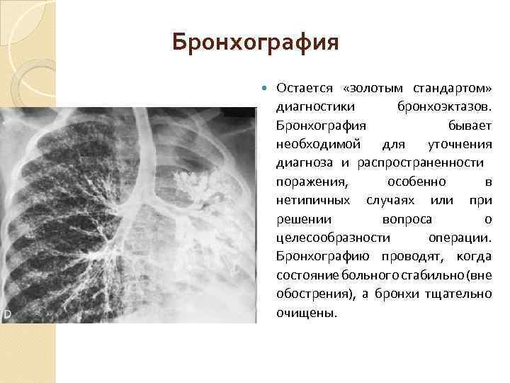 Бронхография Остается «золотым стандартом» диагностики бронхоэктазов. Бронхография бывает необходимой для уточнения диагноза и распространенности