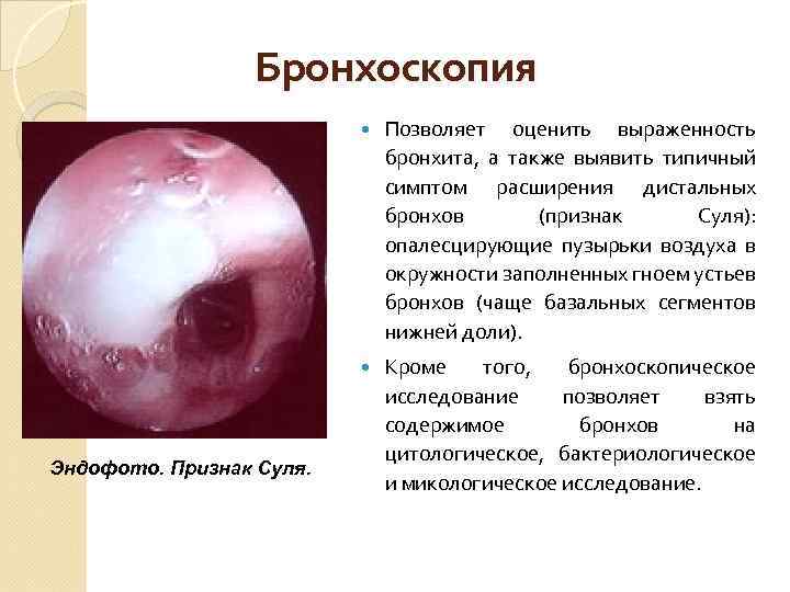 Бронхоскопия Эндофото. Признак Суля. Позволяет оценить выраженность бронхита, а также выявить типичный симптом расширения