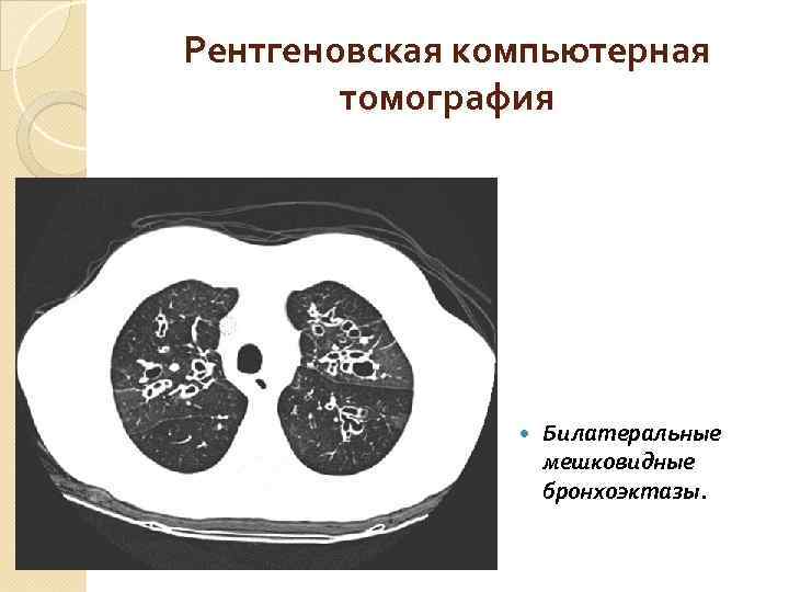 Кт картина бронхоэктазов