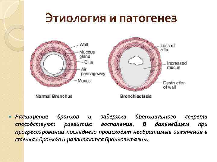 Усиление и обогащение сосудисто бронхиального рисунка