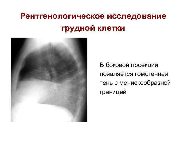 Рентгенологическое исследование грудной клетки В боковой проекции появляется гомогенная тень с менискообразной границей 