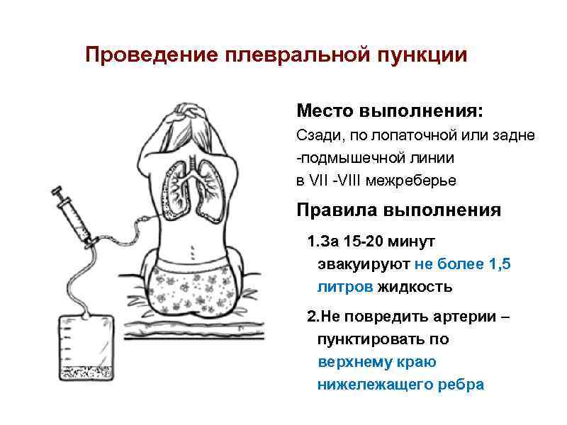 Проведение плевральной пункции Место выполнения: Сзади, по лопаточной или задне -подмышечной линии в VII