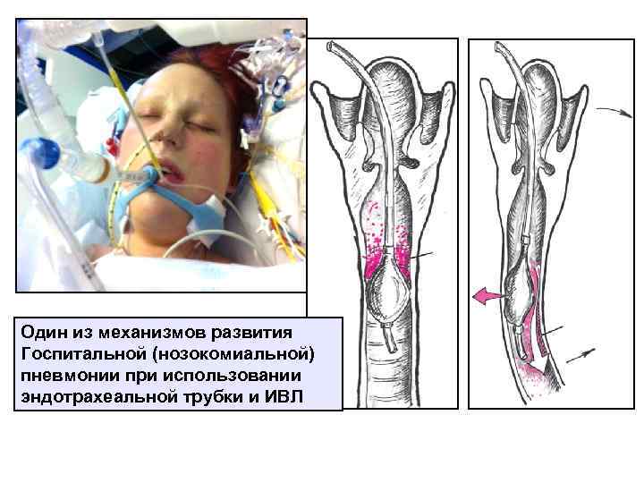 Один из механизмов развития Госпитальной (нозокомиальной) пневмонии при использовании эндотрахеальной трубки и ИВЛ 