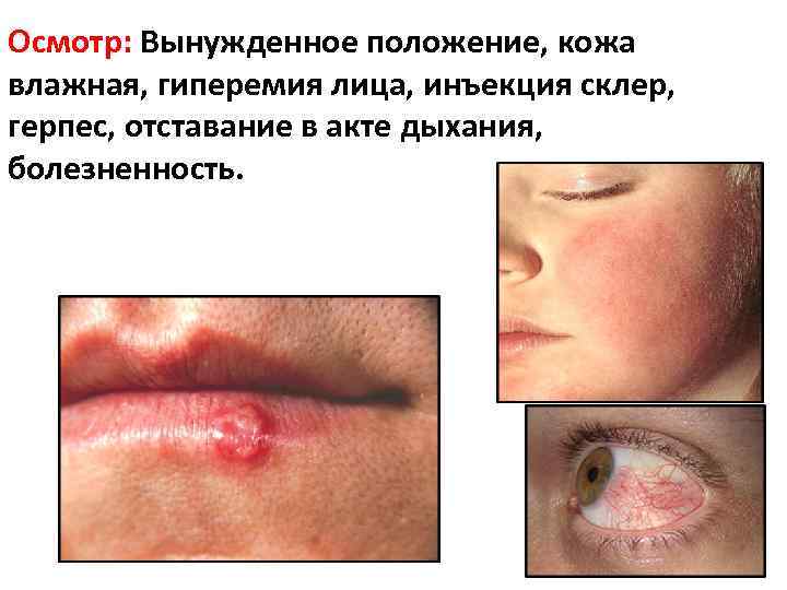 Осмотр: Вынужденное положение, кожа влажная, гиперемия лица, инъекция склер, герпес, отставание в акте дыхания,