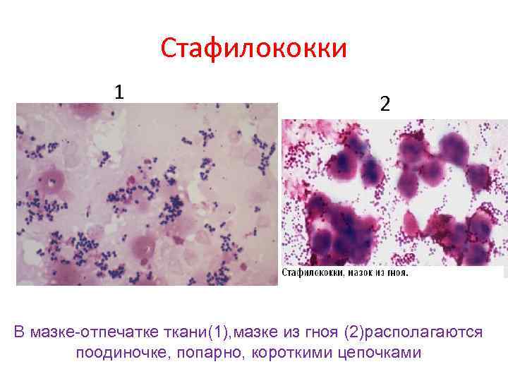 Стафилококки 1 2 В мазке-отпечатке ткани(1), мазке из гноя (2)располагаются поодиночке, попарно, короткими цепочками
