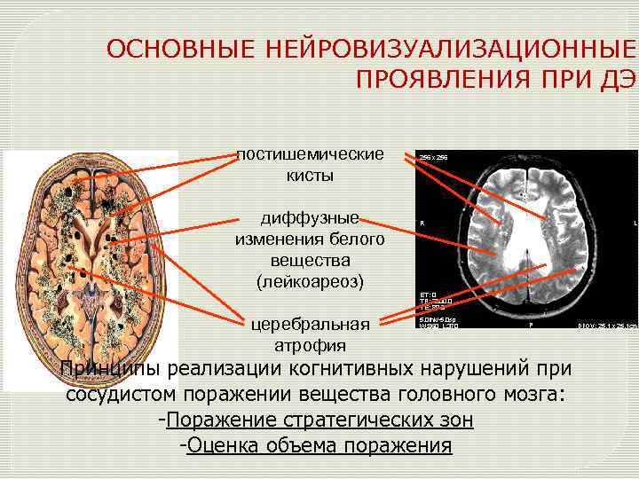 Картина очаговых изменений вещества мозга дисциркуляторного характера и постишемического характера