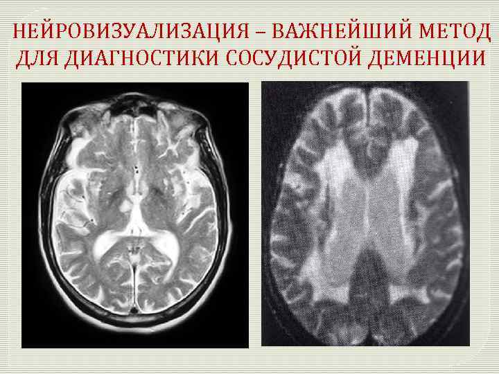 НЕЙРОВИЗУАЛИЗАЦИЯ – ВАЖНЕЙШИЙ МЕТОД ДЛЯ ДИАГНОСТИКИ СОСУДИСТОЙ ДЕМЕНЦИИ 