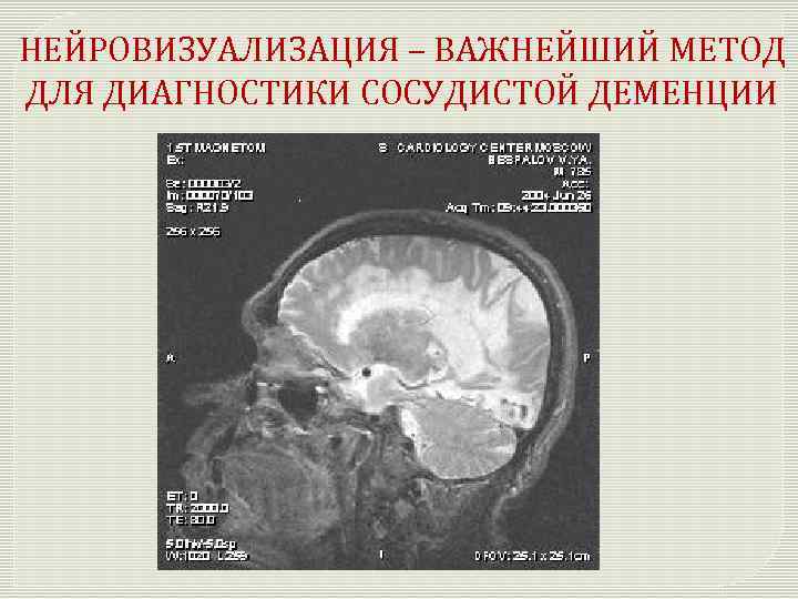 НЕЙРОВИЗУАЛИЗАЦИЯ – ВАЖНЕЙШИЙ МЕТОД ДЛЯ ДИАГНОСТИКИ СОСУДИСТОЙ ДЕМЕНЦИИ 