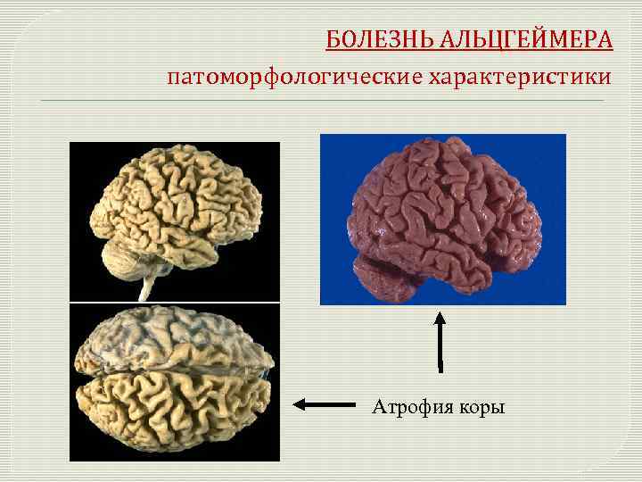 БОЛЕЗНЬ АЛЬЦГЕЙМЕРА патоморфологические характеристики Атрофия коры 