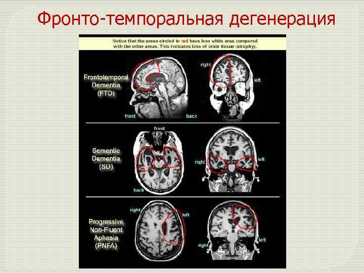 Фронто-темпоральная дегенерация 