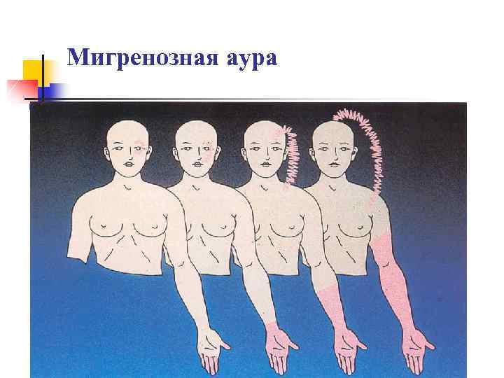 Мигренозная аура 