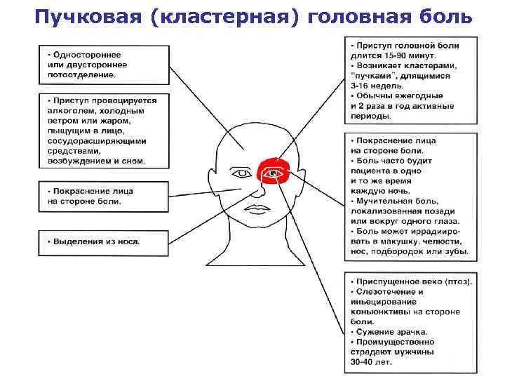 Пучковая (кластерная) головная боль 