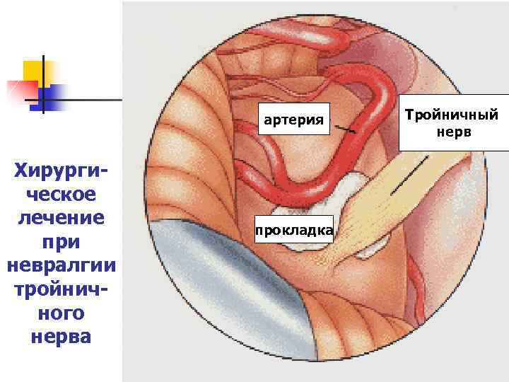 артерия Хирургическое лечение при невралгии тройничного нерва прокладка Тройничный нерв 