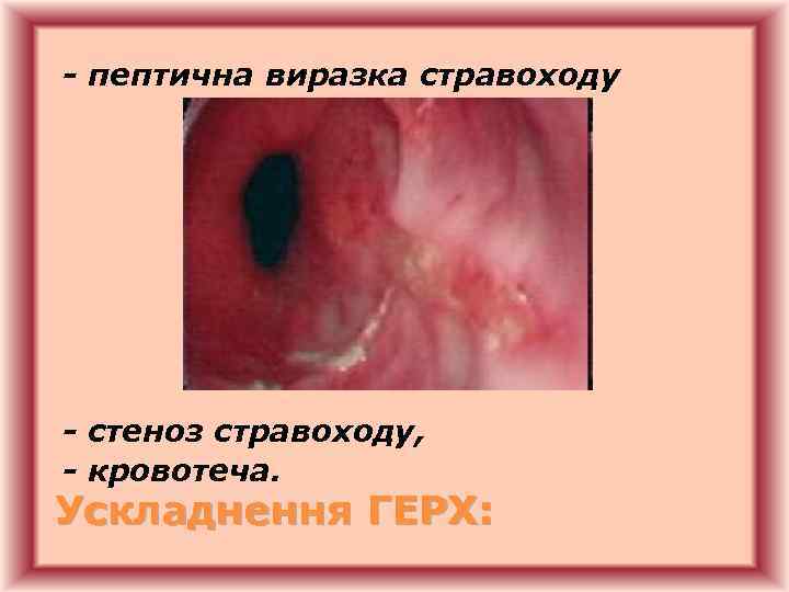 - пептична виразка стравоходу - стеноз стравоходу, - кровотеча. Ускладнення ГЕРХ: 