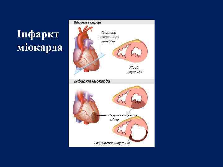 Інфаркт міокарда 