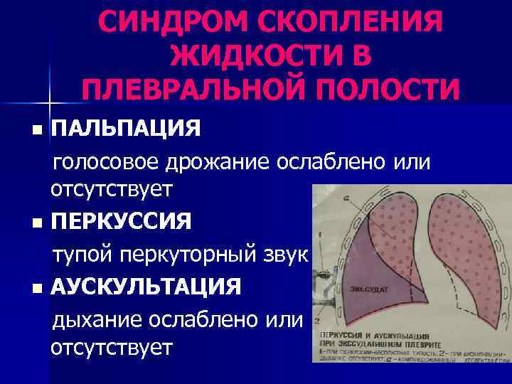 СИНДРОМ СКОПЛЕНИЯ ЖИДКОСТИ В ПЛЕВРАЛЬНОЙ ПОЛОСТИ ПАЛЬПАЦИЯ голосовое дрожание ослаблено или отсутствует n ПЕРКУССИЯ