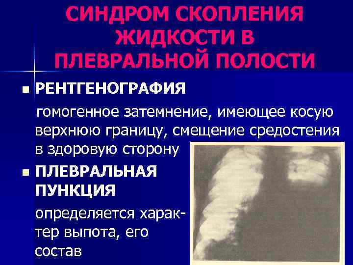 СИНДРОМ СКОПЛЕНИЯ ЖИДКОСТИ В ПЛЕВРАЛЬНОЙ ПОЛОСТИ РЕНТГЕНОГРАФИЯ гомогенное затемнение, имеющее косую верхнюю границу, смещение