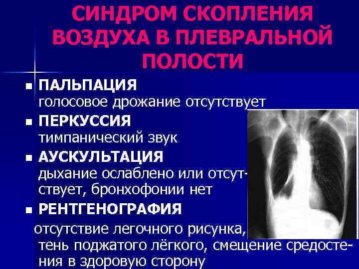 СИНДРОМ СКОПЛЕНИЯ ВОЗДУХА В ПЛЕВРАЛЬНОЙ ПОЛОСТИ ПАЛЬПАЦИЯ голосовое дрожание отсутствует n ПЕРКУССИЯ тимпанический звук