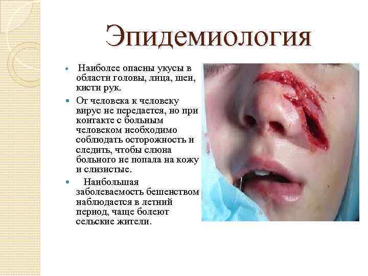 Эпидемиология Наиболее опасны укусы в области головы, лица, шеи, кисти рук. От человека к