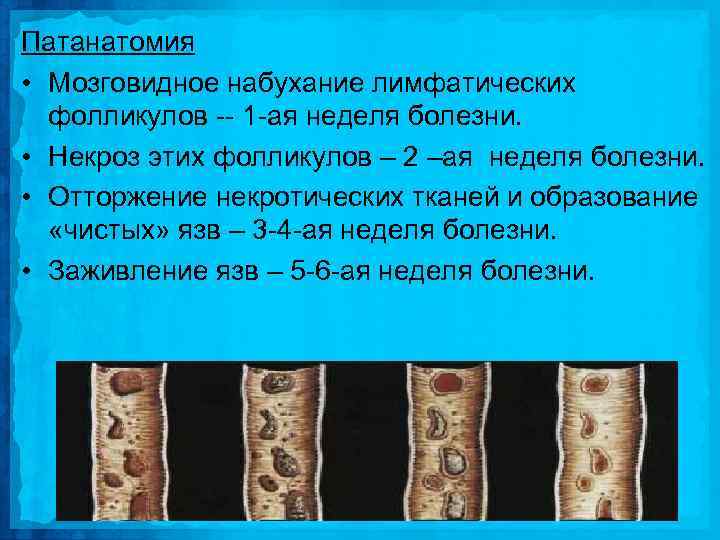 Патанатомия • Мозговидное набухание лимфатических фолликулов 1 ая неделя болезни. • Некроз этих фолликулов