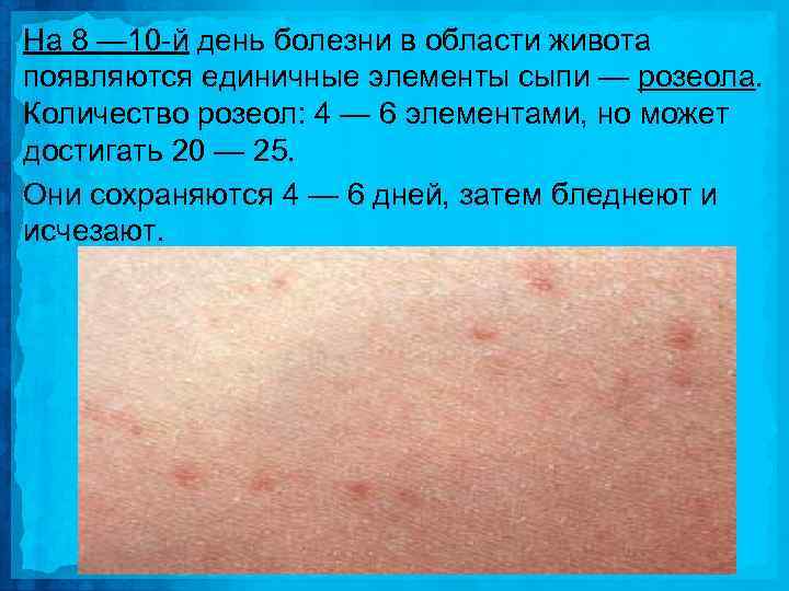 На 8 — 10 й день болезни в области живота появляются единичные элементы сыпи