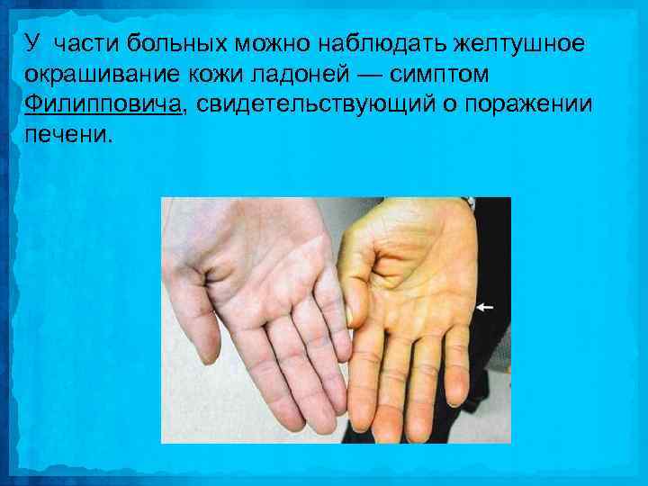 У части больных можно наблюдать желтушное окрашивание кожи ладоней — симптом Филипповича, свидетельствующий о