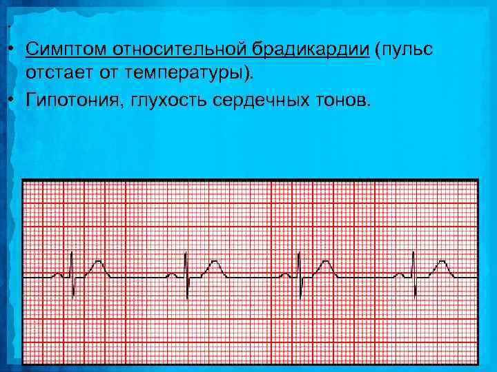 . • Симптом относительной брадикардии (пульс отстает от температуры). • Гипотония, глухость сердечных тонов.