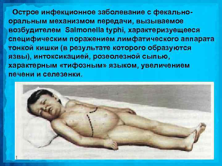 Острое инфекционное заболевание с фекальнооральным механизмом передачи, вызываемое возбудителем Salmonella typhi, характеризуещееся специфическим поражением