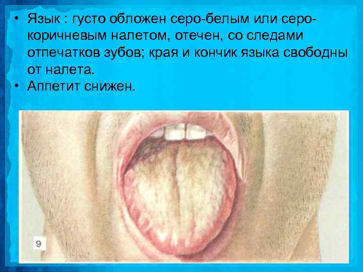  • Язык : густо обложен серо белым или серо коричневым налетом, отечен, со