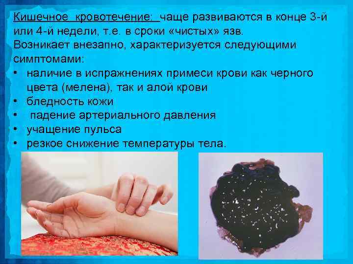 Кишечное кровотечение: чаще развиваются в конце 3 й или 4 й недели, т. е.