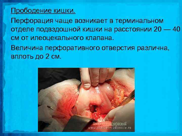 Прободение кишки. Перфорация чаще возникает в терминальном отделе подвздошной кишки на расстоянии 20 —