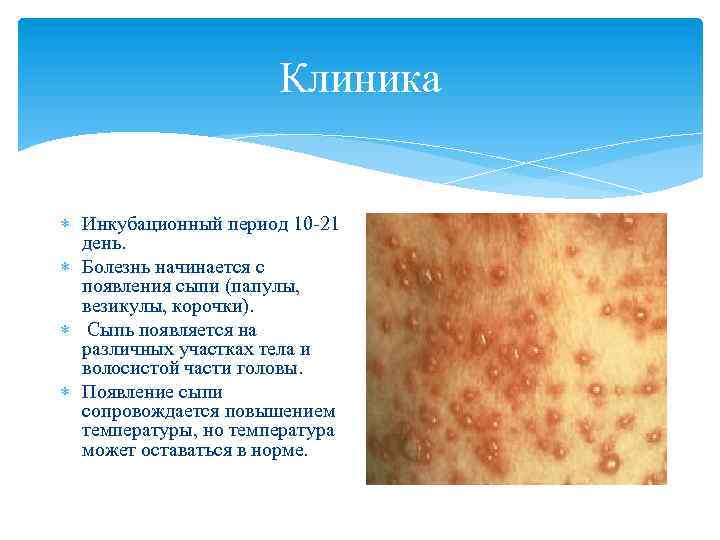Клиника Инкубационный период 10 -21 день. Болезнь начинается с появления сыпи (папулы, везикулы, корочки).