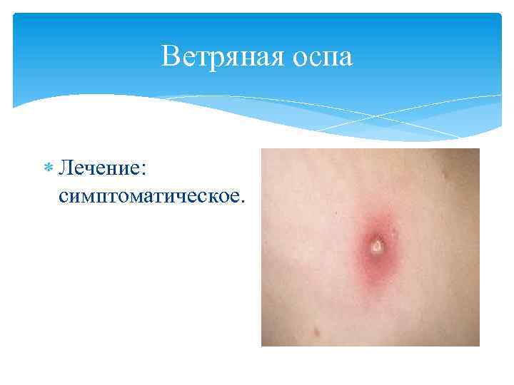 Ветряная оспа Лечение: симптоматическое. 
