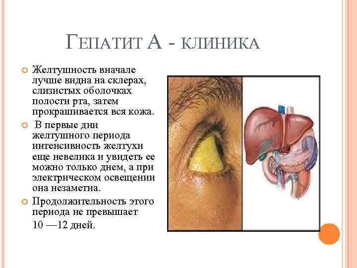 ГЕПАТИТ А КЛИНИКА Желтушность вначале лучше видна на склерах, слизистых оболочках полости рта, затем