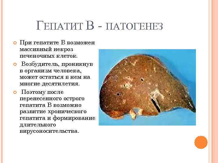 ГЕПАТИТ В ПАТОГЕНЕЗ При гепатите В возможен массивный некроз печеночных клеток. Возбудитель, проникнув в