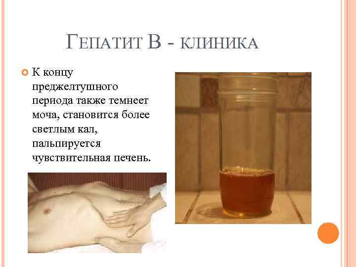 ГЕПАТИТ В КЛИНИКА К концу преджелтушного периода также темнеет моча, становится более светлым кал,