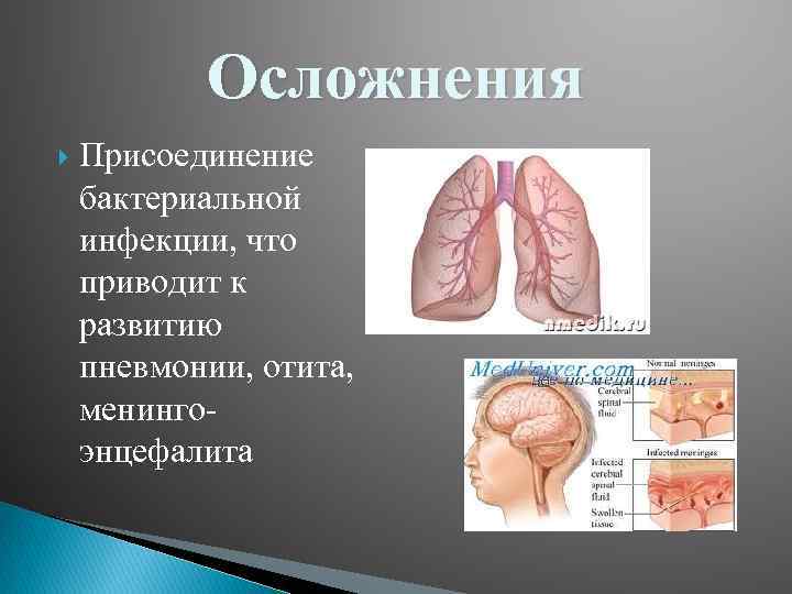 Осложнения Присоединение бактериальной инфекции, что приводит к развитию пневмонии, отита, менингоэнцефалита 